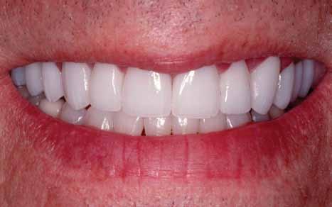 Solution for a severely fractured tooth: Porcelain Crown A crown (or cap) is a covering that encases the entire tooth surface.