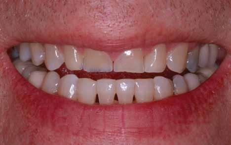 Although there are several types of crowns, porcelain (tooth-colored crowns) is the most popular, because they resemble your natural teeth.