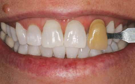 Smile Wish: Whiter, Brighter Smiles As you age, you may begin to notice that your teeth are not quite the same shade of white as they were in