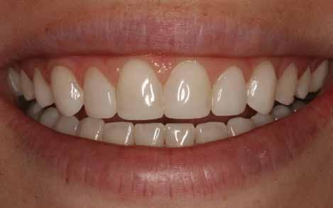 Smile Wish: To Correct Stained or Discolored Fillings on Front Teeth All dental restorations (fillings) may
