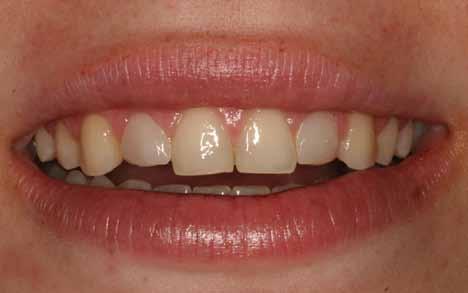 If a dental restoration changes color, that process can occur because the surrounding tooth structure is