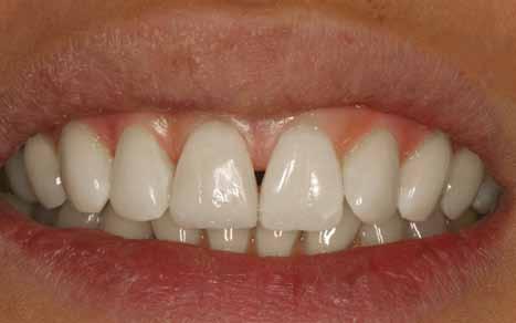 Solution for an area with a stained or discolored dental filling: A New