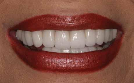 Solution for areas with extensive old existing fillings: Porcelain Veneers Porcelain veneers offer a more dramatic