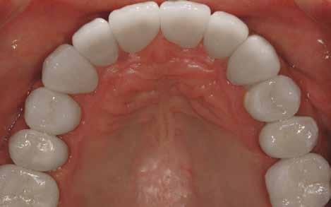 Solution for replacement of extensive old amalgam fillings: Porcelain Crowns A crown (or cap) is a covering that