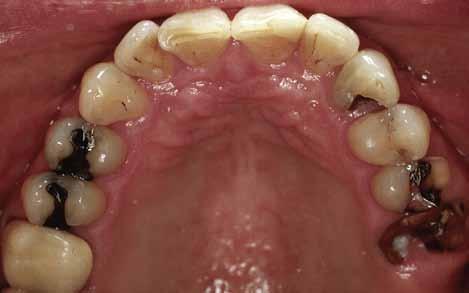 Although there are several types of crowns, porcelain (tooth-colored crowns) are the most popular, because they
