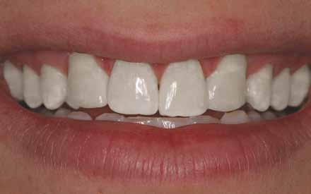 Smile Wish: To Eliminate Long or Uneven Front Teeth Best Solution: Recontouring It is not uncommon for a tooth to be slightly longer or have a different shape than its neighbors.
