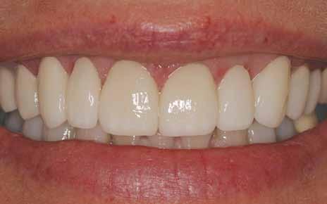 Smile Wish: To Eliminate Short Teeth and a Gummy Smile Many people show small teeth with a lot of red gum tissue.