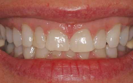 Those people usually do not have short teeth and most commonly they just have too much gum tissue, which simply needs to be removed in order to expose more tooth