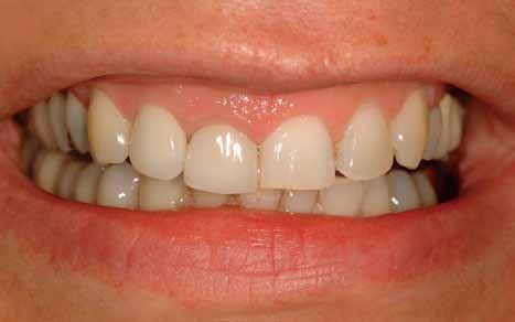 First Solution: Gum Recontouring/Gingivectomy This solution is for the patient with an uneven gum line, overgrown gum tissue or thick gums.