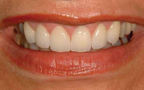 Excessive gum tissue can be genlty recontoured, often using a laser.