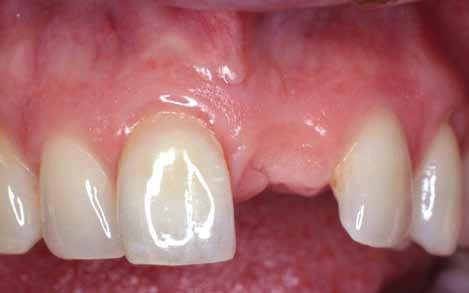 A fixed bridge is cemented into place using teeth adjacent to the missing space to support a