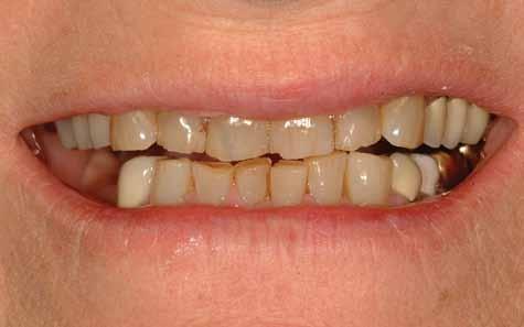 Solutions for a younger smile: Replace any missing teeth to prevent your bite from collapsing and tissue from sagging.