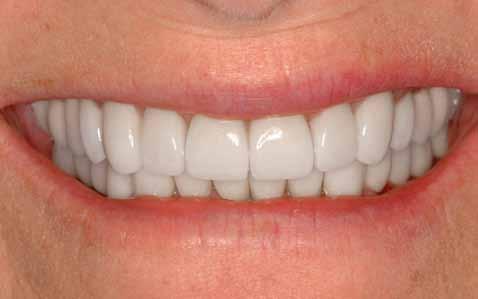 This disease leads to gum recession and bone loss around your teeth, which creates spaces between your teeth.