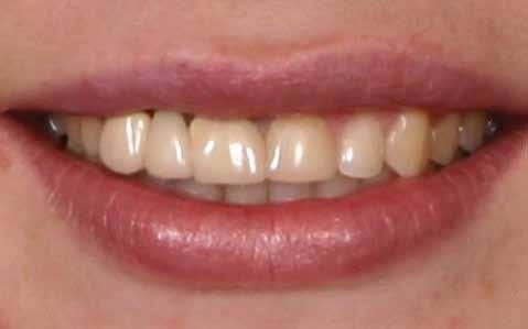 Solutions for a younger smile: Replace old stained and discolored fillings Cover very stained