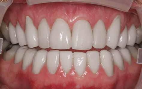 If whitening is not the best solution for you If none of the fixes are for you because your teeth are hard to whiten, you may need veneers to