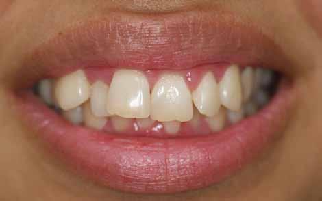 Smile Wish: To Correct Misaligned, Crooked or Overlapping Teeth It is important to correct