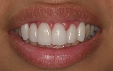 It is also important to have straight teeth in order to have good oral health.