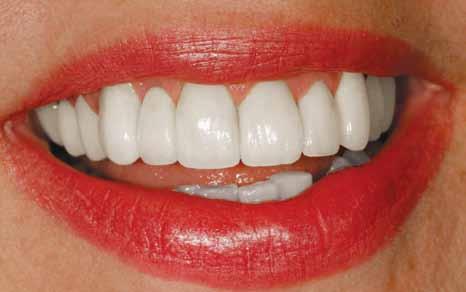Solution for minimally misshapen and crooked teeth without orthodontics: Porcelain Veneers Porcelain veneers offer a dramatic