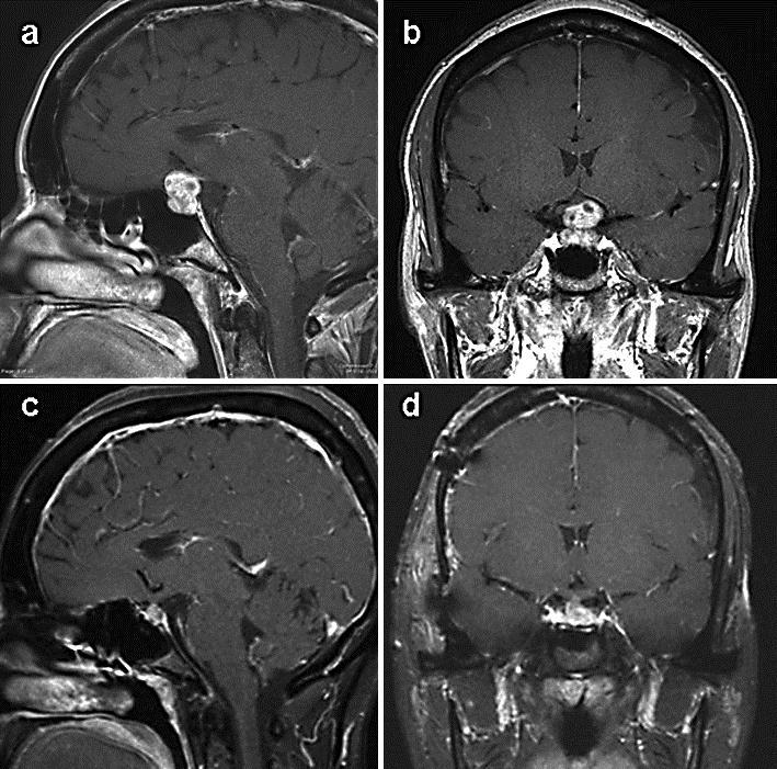 194 Fig. 2. Preoperative T1 sagittal (a) and coronal (b) MRI showing compression of the tumor on the optic chiasm.