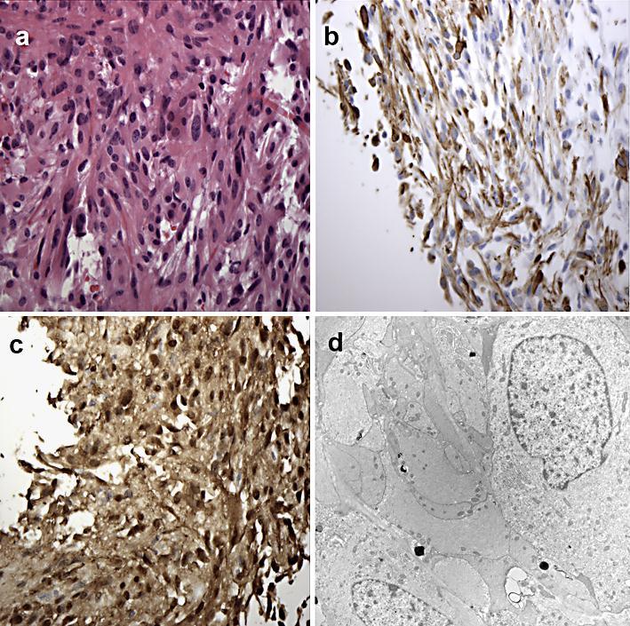 195 Fig. 3. Pathology of pituicytoma. a Tumor composed of spindle-shaped cells arranged in interlacing fascicle cells. HE stain, 40. b Positive glial fibrillary acidic protein staining.
