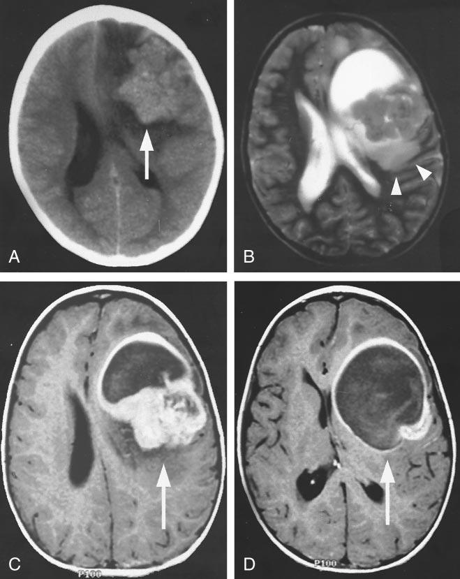 246 PORT AJNR: 23, February 2002 FIG 4. The classic CT and MR imaging appearance of an astroblastoma in a 5-year-old female patient (patient 4).