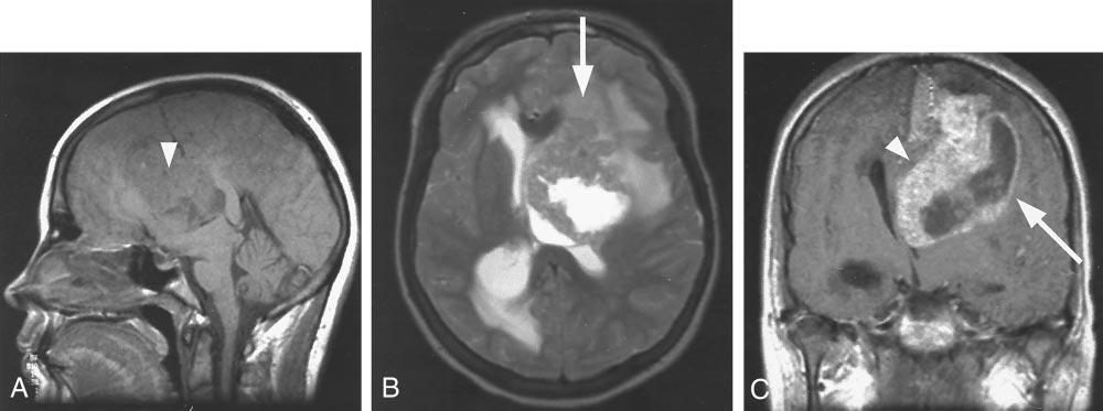 B, Axial T2-weighted image (7935/ 115/1) depicts the relative lack of peritumoral T2 hyperintensity (representing vasogenic edema or tumor infiltration or both) given the large tumor size