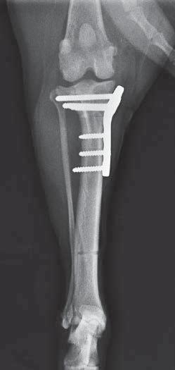 The distal portion of the tibia is stabilized using