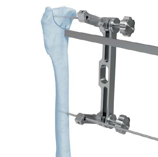 The cut is made approximately halfway through the bone. Care must be taken to ensure the cut is made parallel to the distal jig pin.