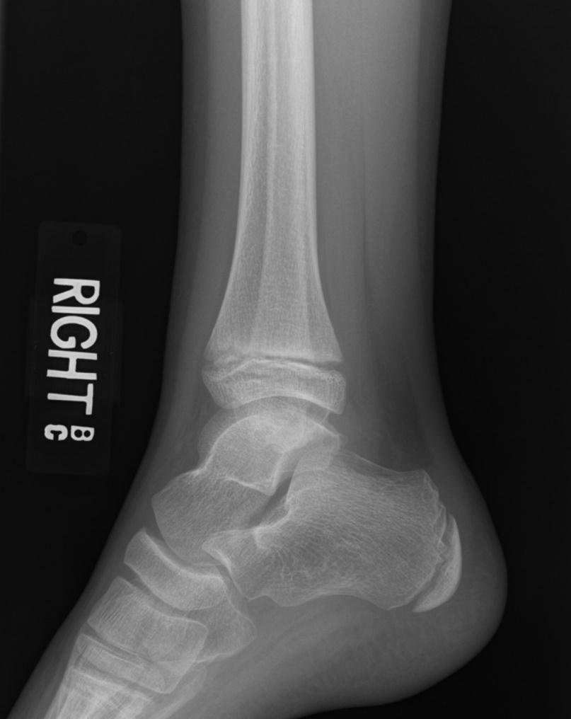 X-ray: Mortise and lateral view right ankle showed a shallow defect in the medial aspect of the talus measuring 9 mm