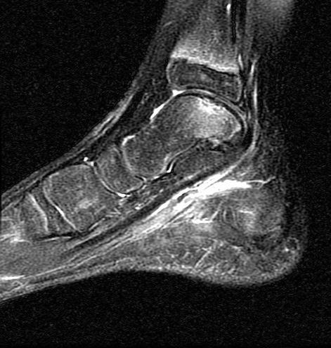 Right Ankle MRI T2-weighted sagittal sequence demonstrated a 9 x 8 mm osteochondritis dissecans (OCD) lesion involving the cortex and subarticular bone of the talus at its medial and posterior