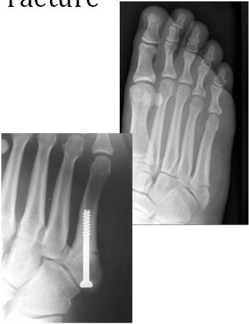 Fracture Fracture of the Base of the 5 th Metatarsal where peroneus brevis attaches Common Fracture Can be a Stress FX or Acute FX  Fracture RICE Place in walking
