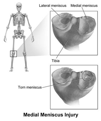 stresses of the knee that pinch the meniscus between the femur and tibia