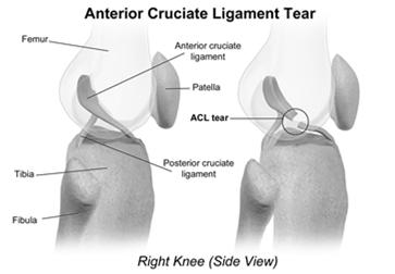 Meniscus Tear Will not heal on own, must be stitched or cleaned up RICE and therapy.