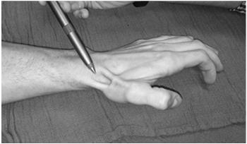fracture until proven otherwise Scaphoid Fracture Place in thumb spica cast or full time thumb