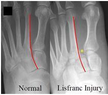 Lisfranc (TMT) joints Key to the transverse arch of the foot Provide structural