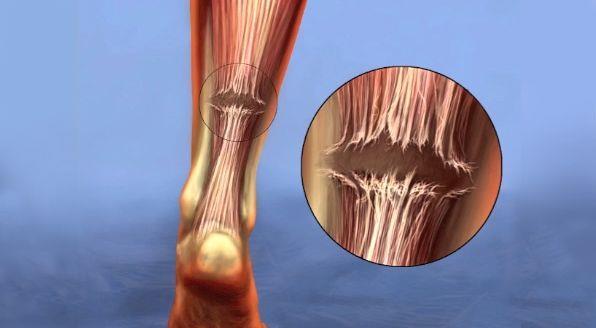 Can feel a defect in the tendon Usually repaired patient is a good candidate Can heal