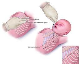 Meconium aspiration Presence, fetal distress Hypoxia during birth, bowel movement Inhaled Complete/partial airway obstruction 91 Meconium aspiration Watery meconium may not require