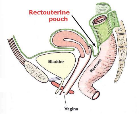 Pouches in female - Rectouterine pouch (Douglas pouch) between rectum and uterus, it also covers the posterior fornix of vagina - Vesicouterine pouch (Uterovesical pouch): between bladder and