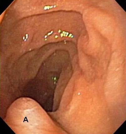 Hepatopancretic ampulla: when the pancreatic duct & the common bile duct join each other before the medial wall