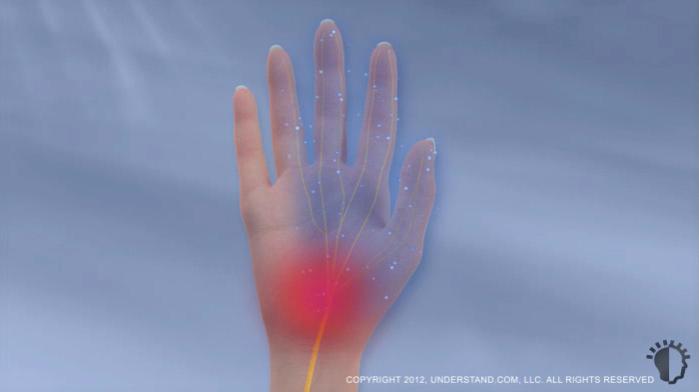 Introduction Carpal tunnel syndrome is a condition in the hand and wrist caused by excessive pressure on the median nerve in the wrist.