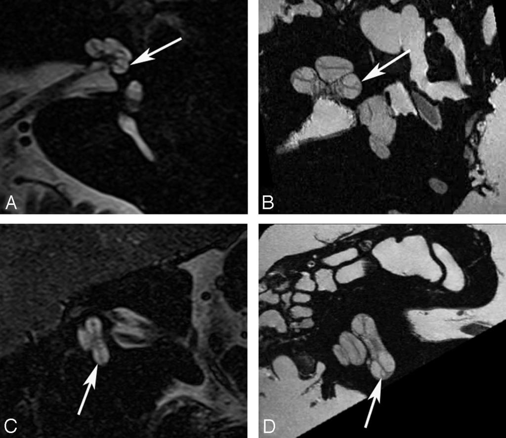 4T oblique sagittal image demonstrates similar findings (arrow). Fig 7. Cochlear duct. B and D, Ex vivo 9.
