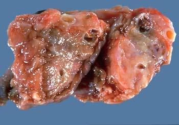 The CF pancreas Cyst Courtesy of Dr.