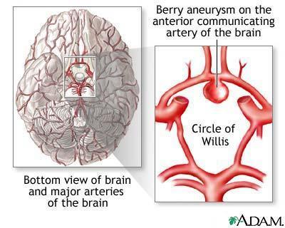 9 Aneurysm Bulge that forms in a