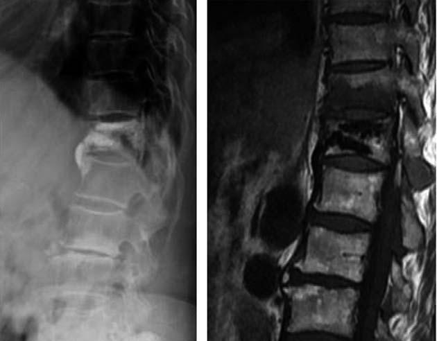 184 / ASJ: Vol. 5, No. 3, 2011 mineral density can result in not only vertebral compression fracture but also new vertebral fractures in adjacent vertebrae. Uppin et al.