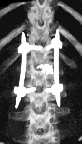 A lumbar spine MRI with STIR sequence demonstrated a