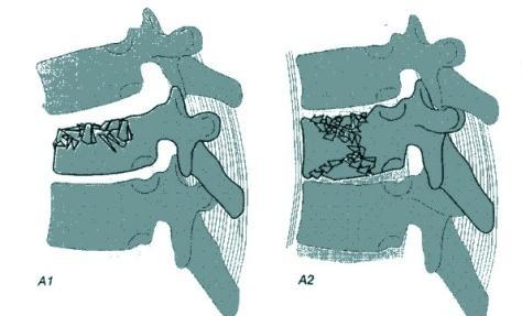 examination 4) No significant retropulsion of bone fragment