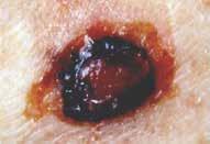 It is characterized by laterally spreading melanocytes within the epidermis, making the assessment of the lateral extent of the melanoma difficult. [1,2] Nodular melanoma is another common subtype.
