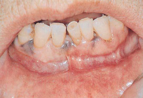 Clinical features The condition presents as a well-defined irregular or diffuse flat area, with a bluish-black discoloration of varying size.