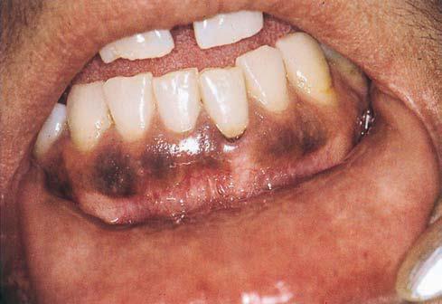 Clinical features Clinically, the most common pattern (bismuth, lead) is a bluish line along the marginal gingiva, or similar spots within the gingival papillae.