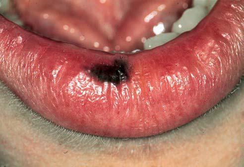 Black Hairy Tongue Hairy tongue may occasionally appear black as a result of the growth of pigment-producing bacteria that colonize the elongated filiform papillae.